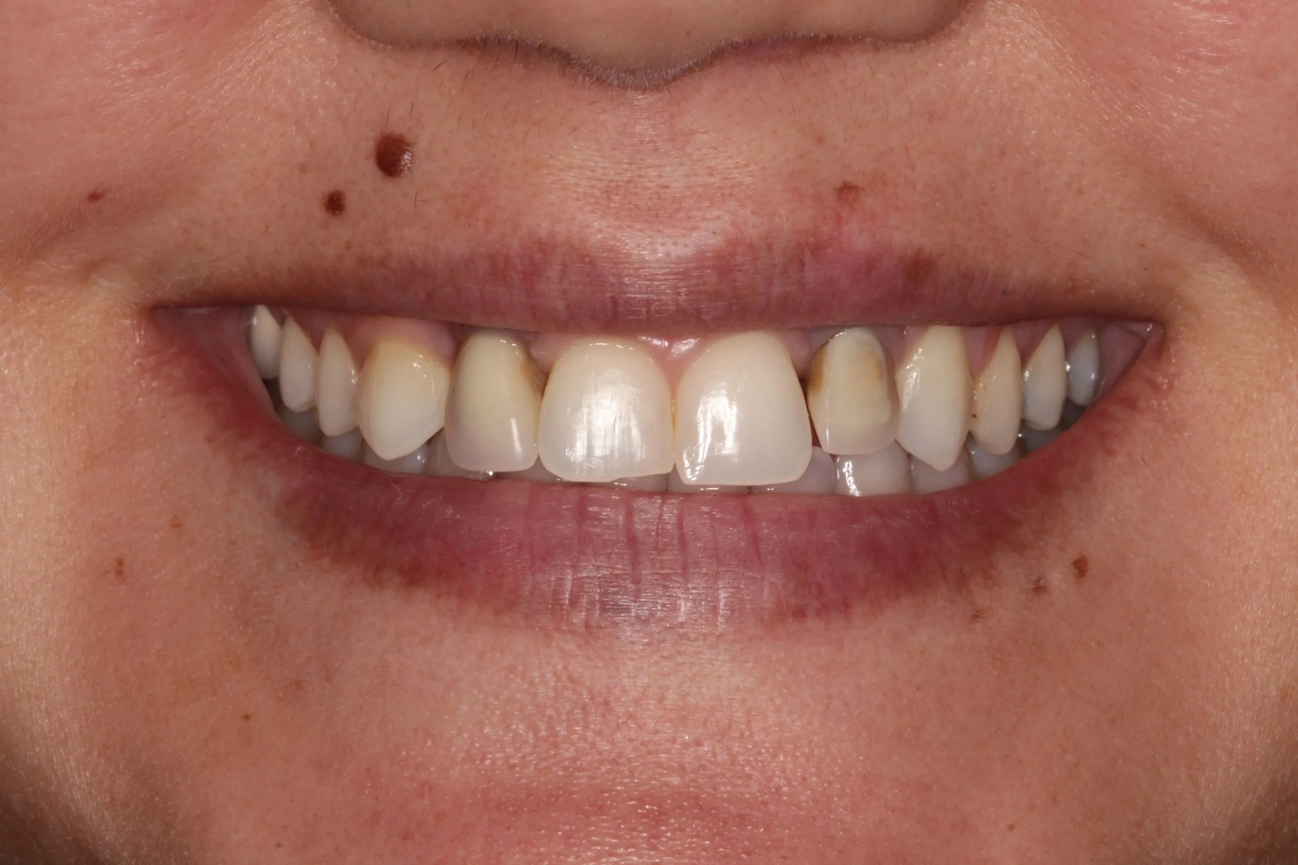 Dentist in Lexington, KY Commonwealth Smiles Smile Gallery