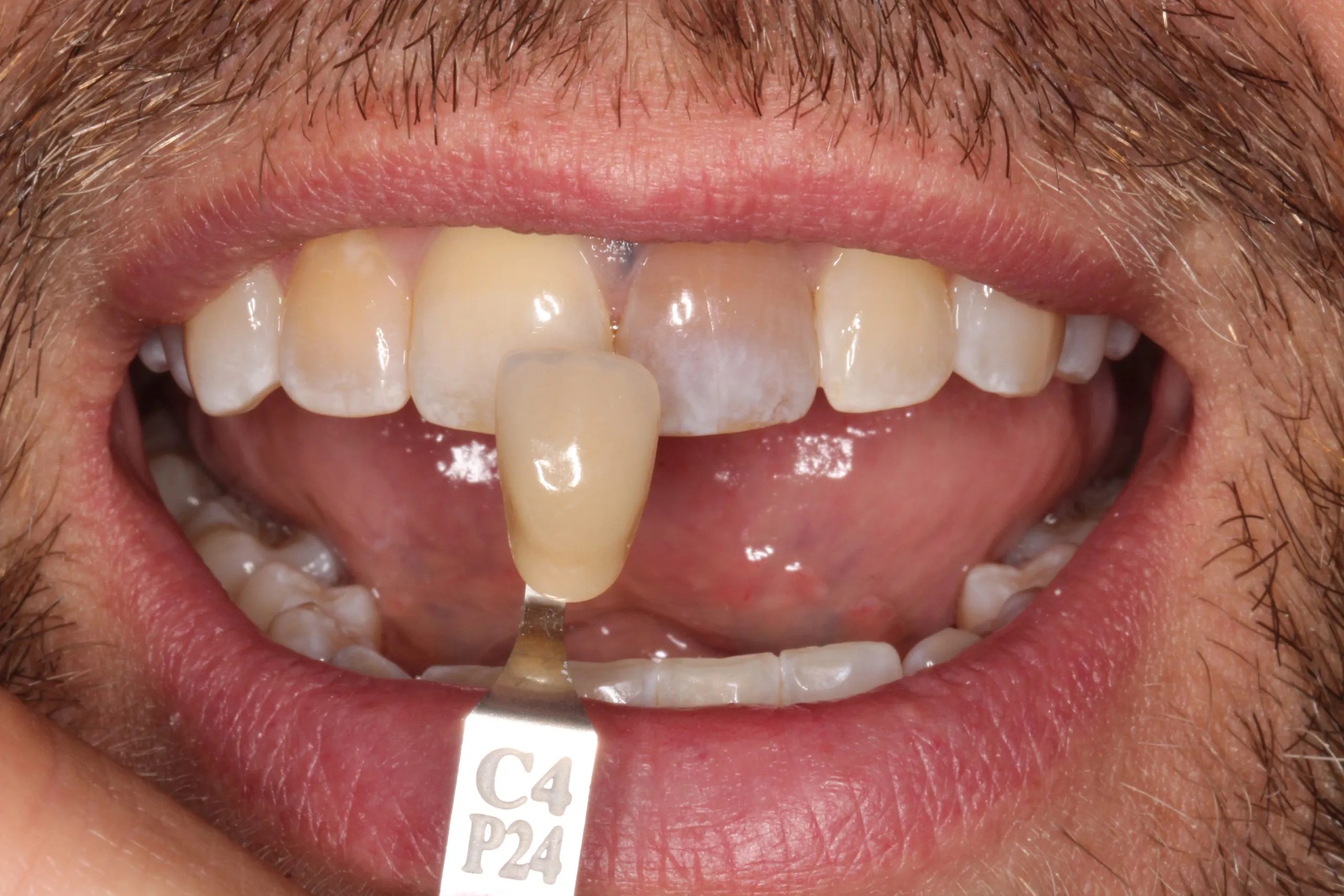 Dentist in Lexington, KY Commonwealth Smiles Smile Gallery