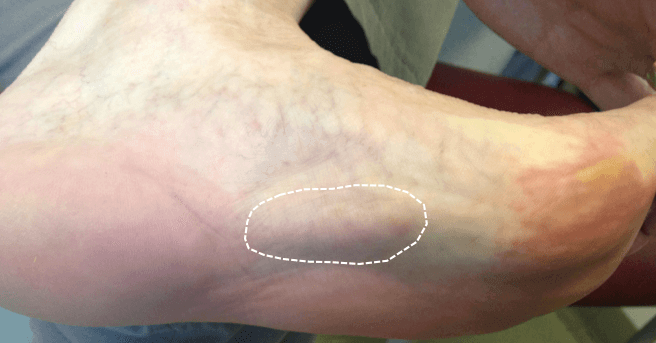 Plantar Fibroma and Fibromatosis Mr Malik at LFAC