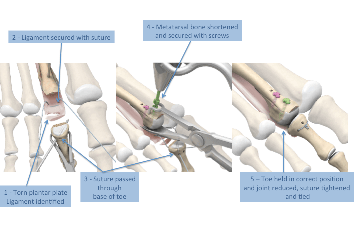 Plantar Plate Injury Plantar Plate Dysfunction LFAC