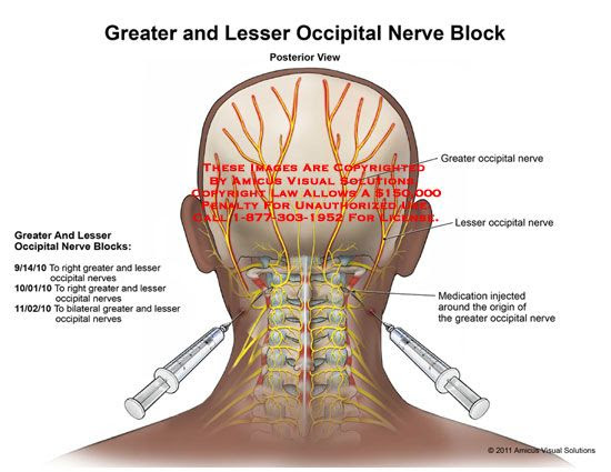 Cervical Radiculopathy Icd 10