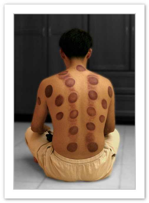 Bodily remedy Fibromyalgia