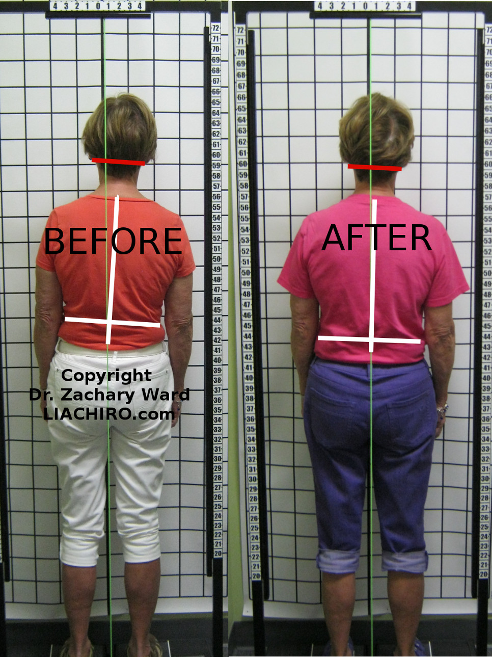 Chiropractic Adjustment Before And After