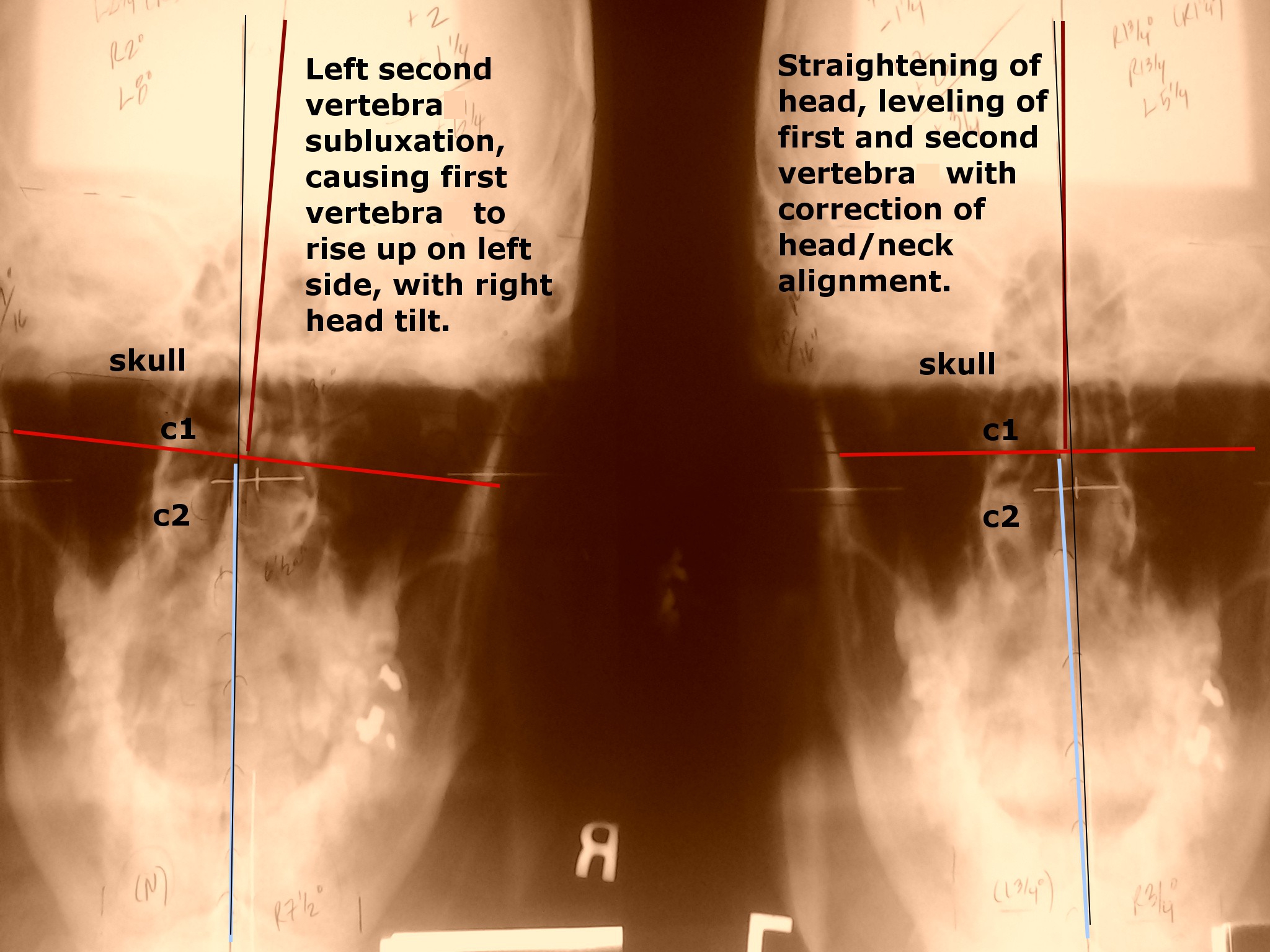 How to hold your spinal alignment - the three major chiropractic