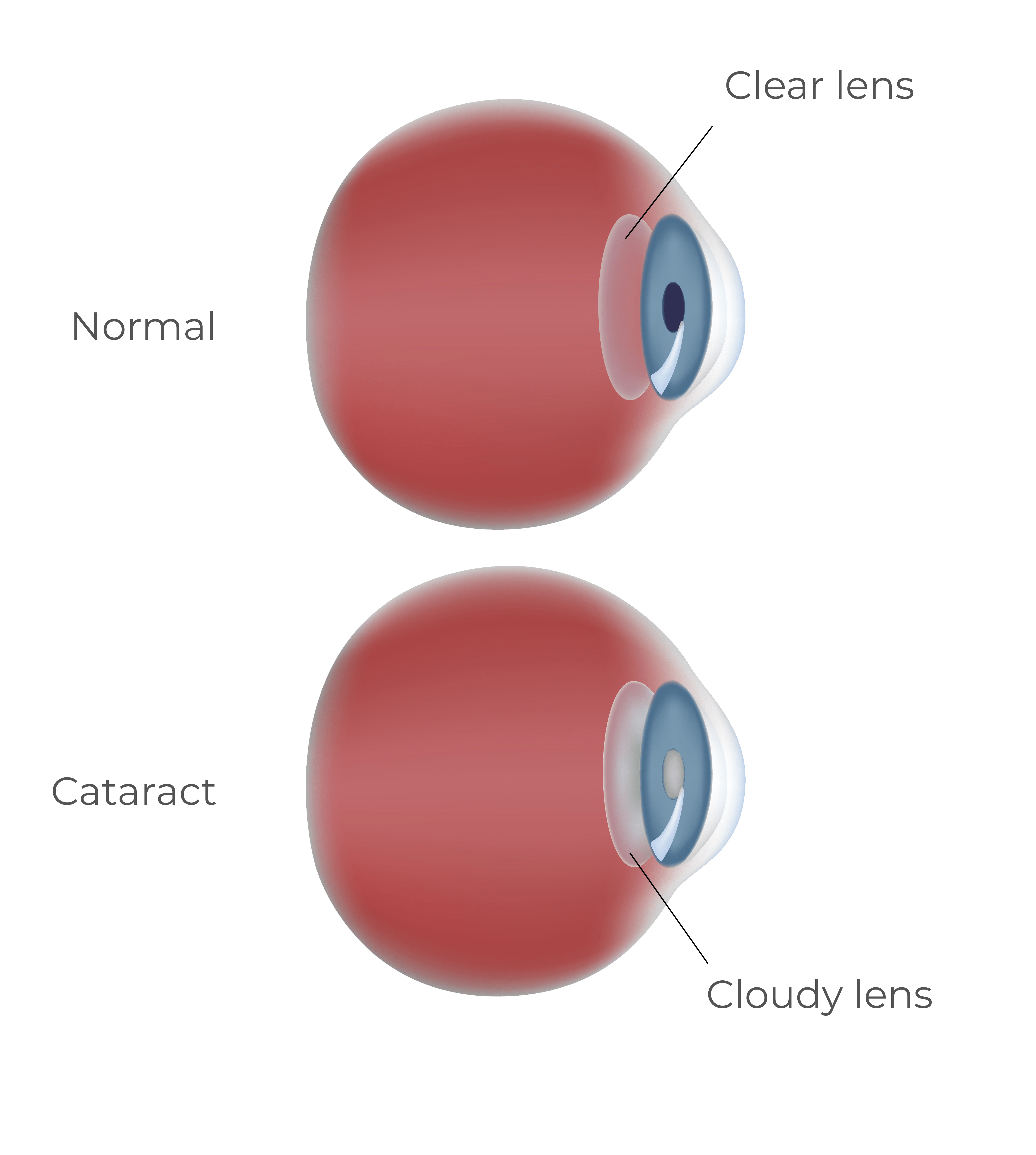 Liberty Lens Medicontur