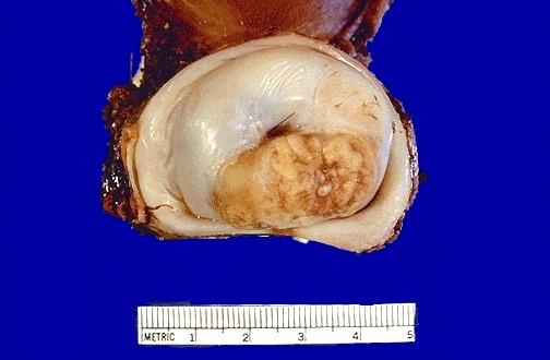 Female Genital Pathology
