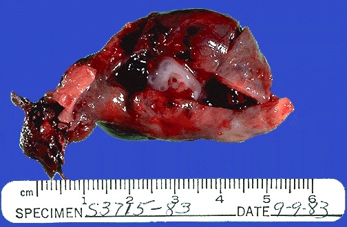 Pathology Outlines Ectopic / tubal pregnancy