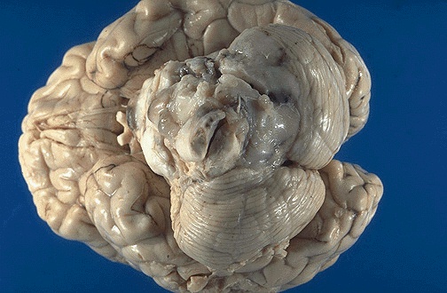 Glioma Glioblastoma Vs Glioma
