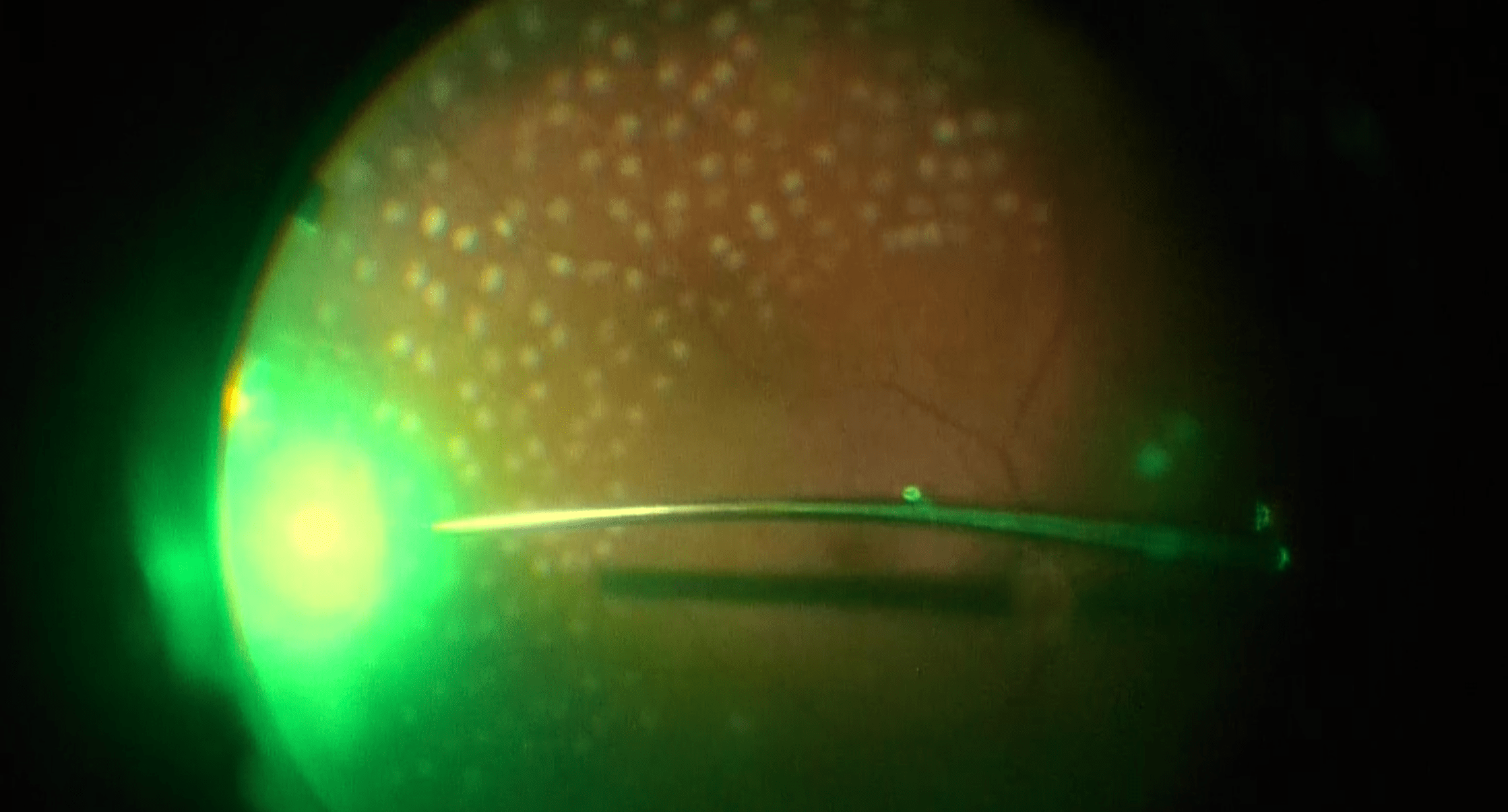 Endolaser Panretinal Photocoagulation (PRP) Wills Eye Library