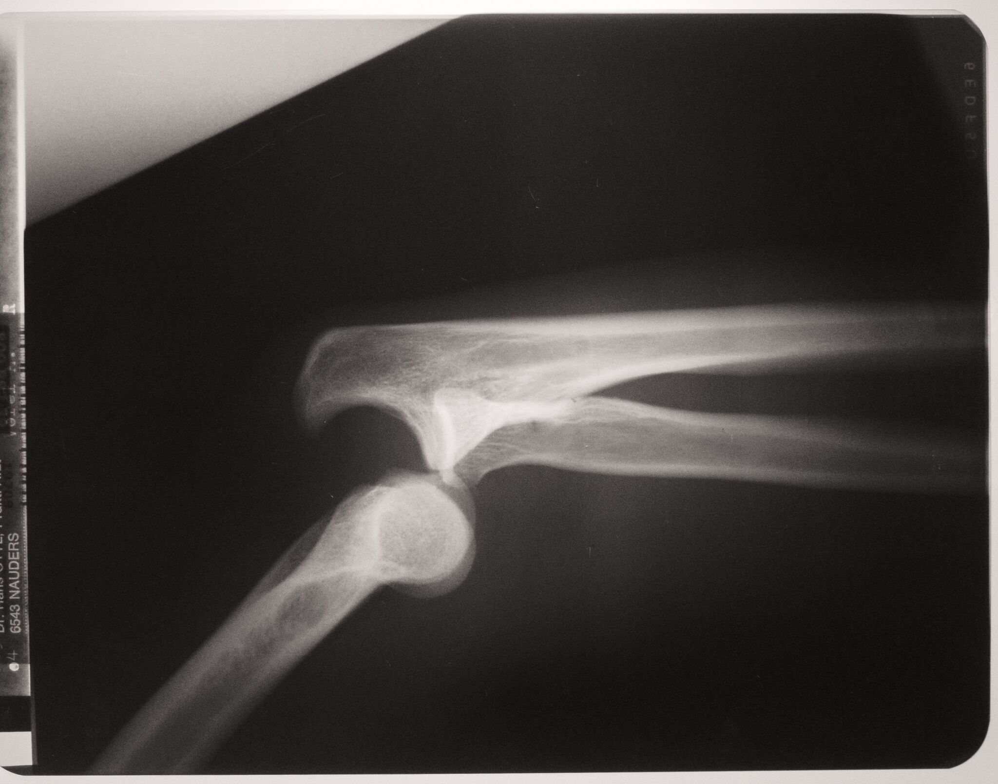 XRay With Dislocated Arm Joints Copyrightfree photo (by M. Vorel) LibreShot