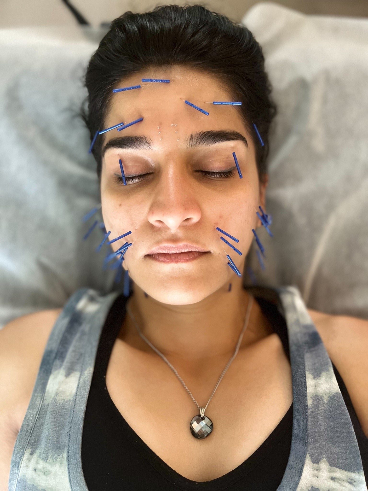How Does Facial Acupuncture Work?