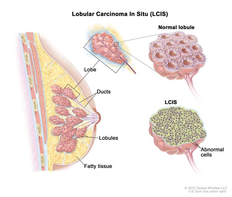 What is invasive lobular carcinoma (ILC)? Life