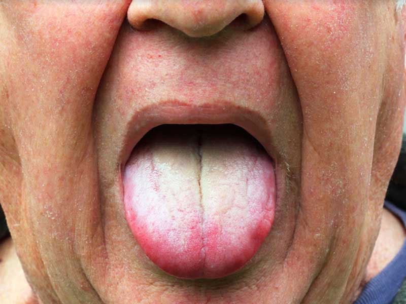 How to get rid of white coated tongue with simple home remedies lifealth