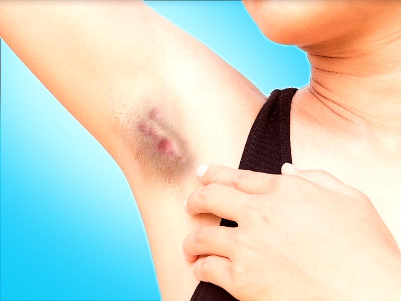 What Are The Remedies To Get Rid Of Painful Lumps In The Armpit lifealth