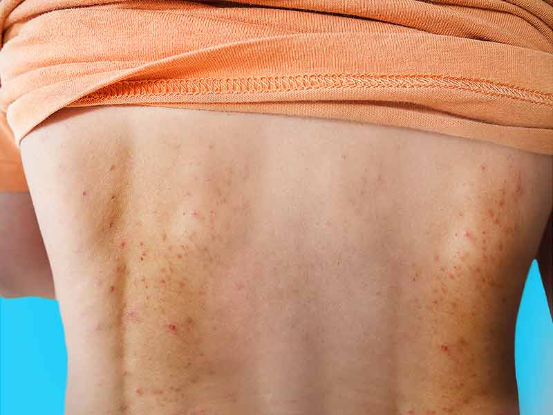 What Are The Tips To Reduce Back Acne lifealth