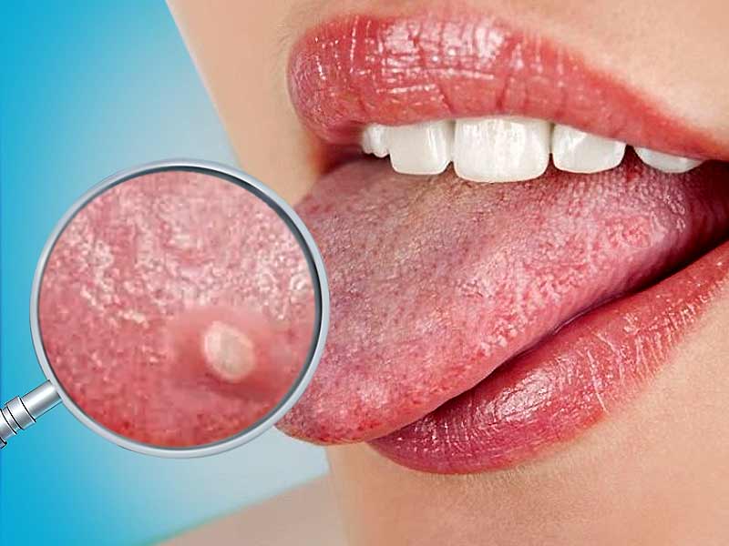 Effective home remedies to deal with the problem of blisters on the