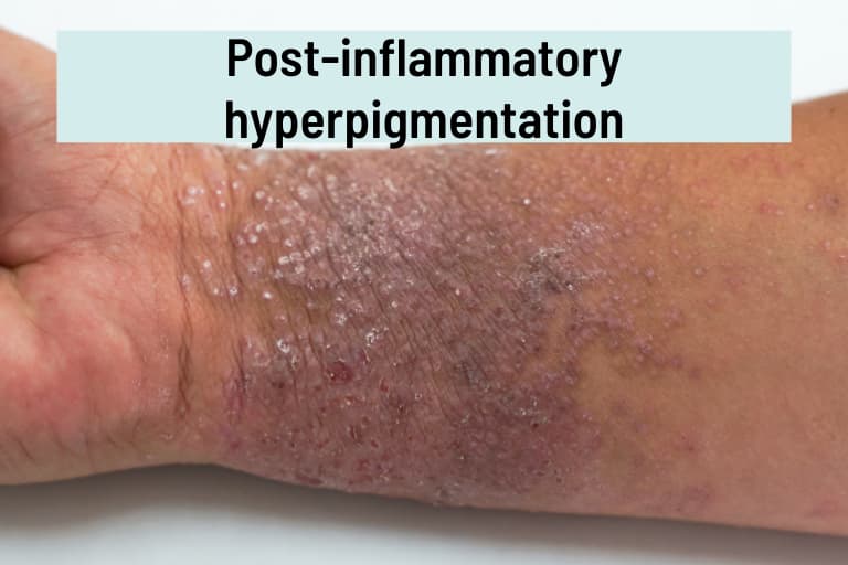 Brown Patches on Skin 16 Causes and Treatments Life Pathdoc