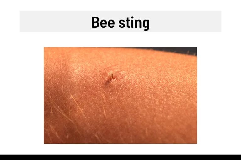 Blisters on Fingers and Hands 13 Causes, Pictures & Treatment