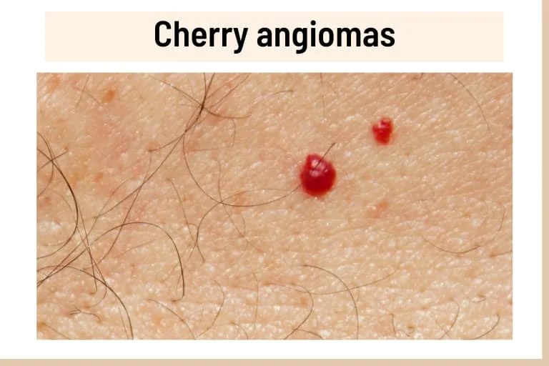 Red Spots on Skin, But Not Itchy 14 Causes, Pictures, Treatment