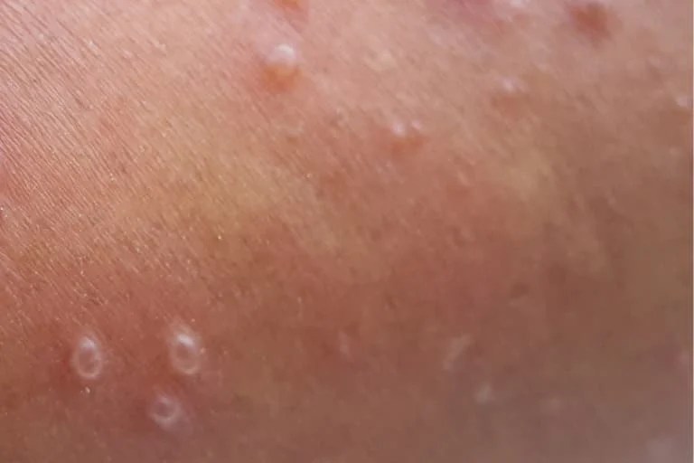 Skin Lesions Types with Chart, Pictures, Causes, Treatment