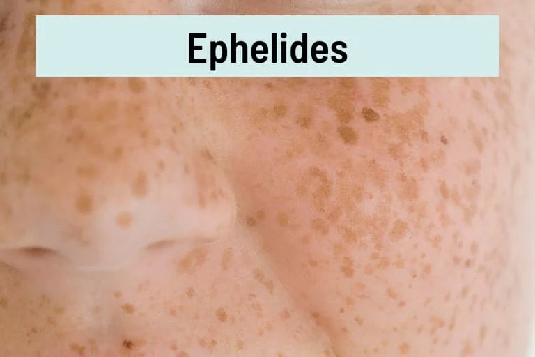 Brown Spots on Skin 17 Causes, Pictures, Treatment