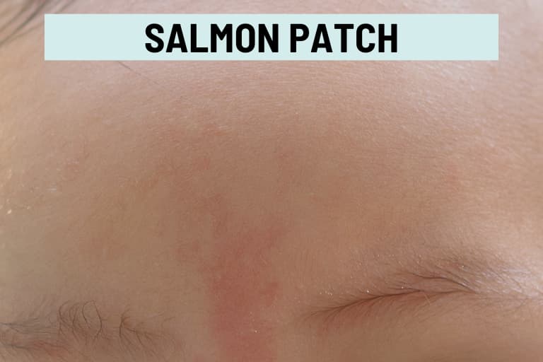 Skin Discoloration Causes, Pictures, and Treatment