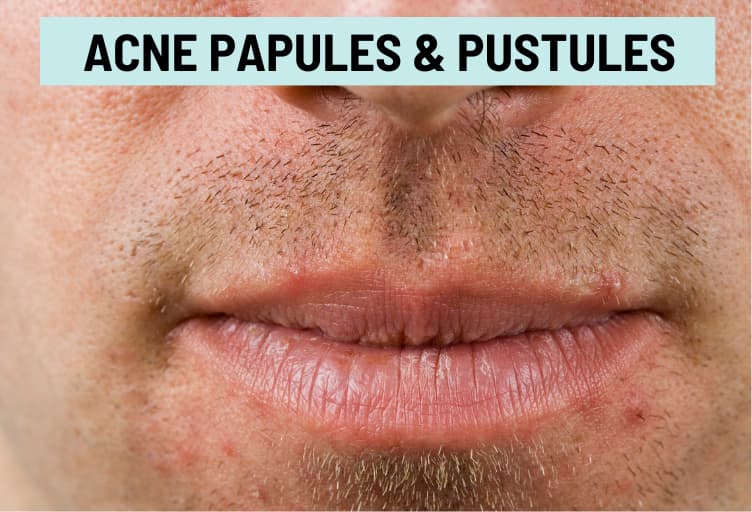 Cold Sore vs. Pimple Pictures and Differences