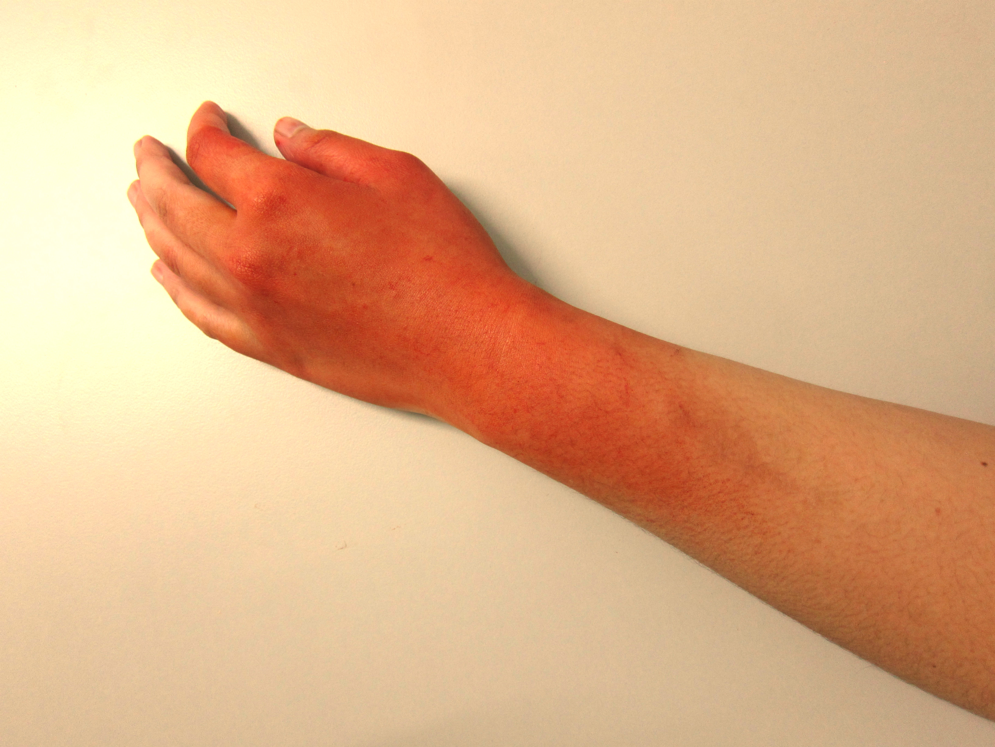 First Aid Treatment for Burns l First Aid Training Tips - Life Saving