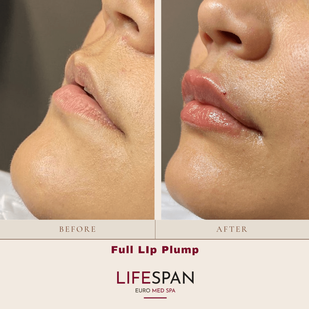 Before & After Lifespan Euro Med Spa