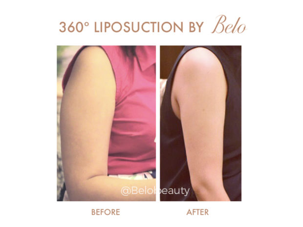 360 Liposuction How It Works and Benefits Inquirer Lifestyle