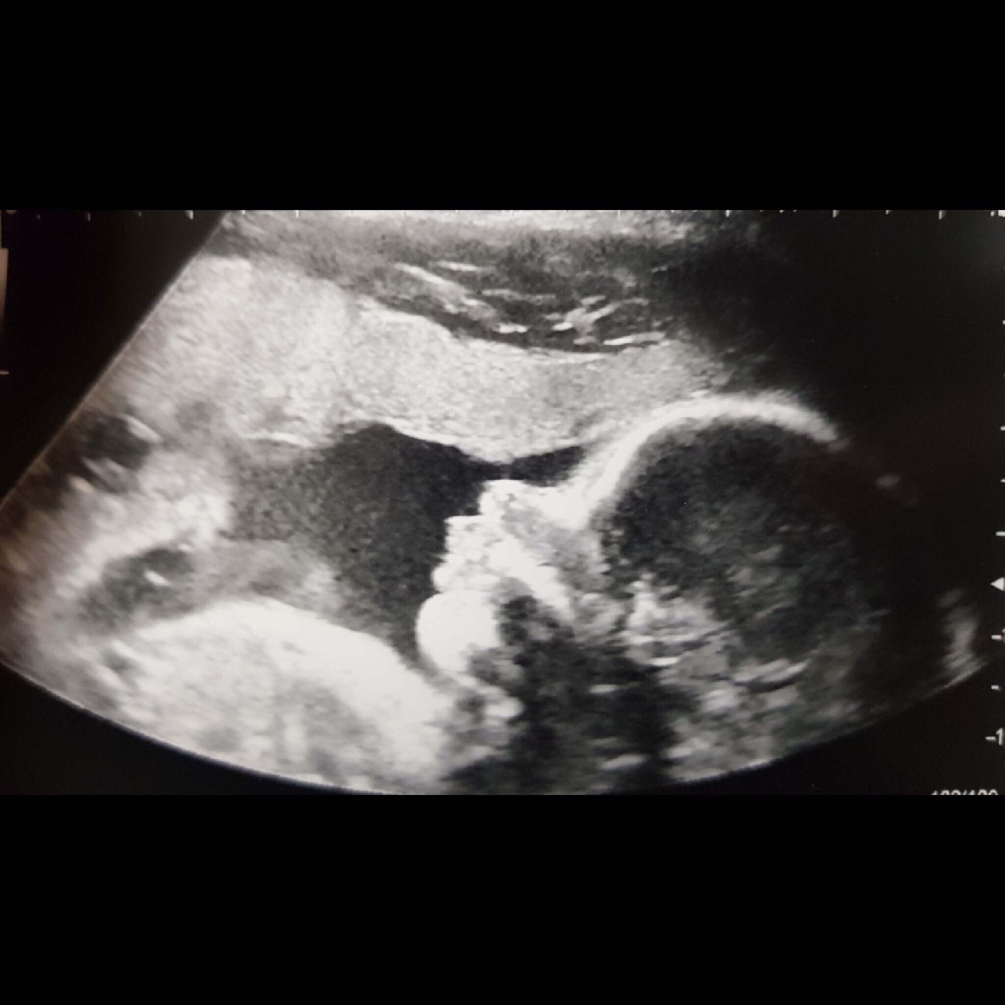 Chronic illness & Maternity Care Life With Caleb