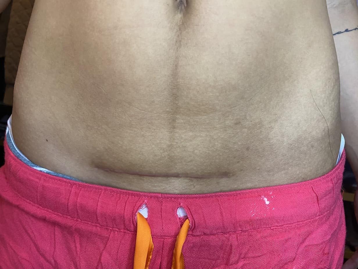 Things About Your Healthy CSection Incision Lifting Motherhood