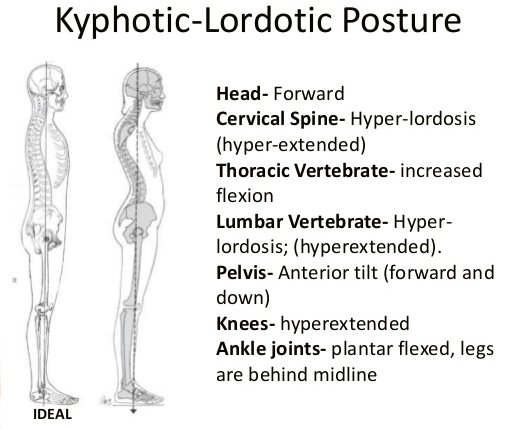 Posture spotlight! kyphosislordosis