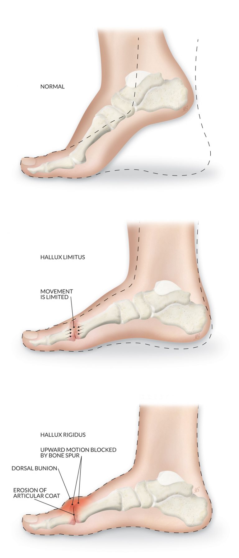 Hallux Rigidus Limbhealing