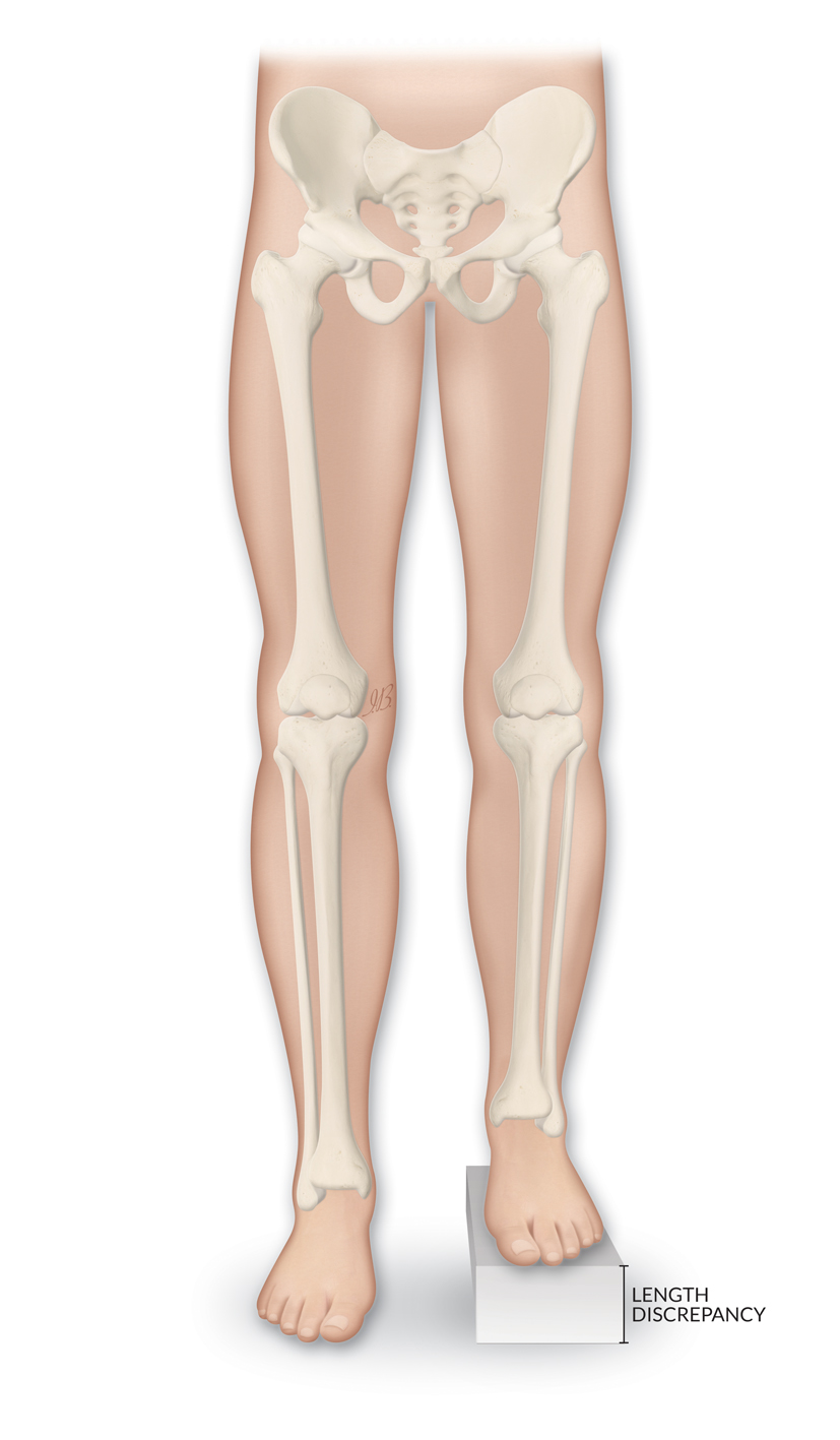Leg Length Discrepancy (LLD)