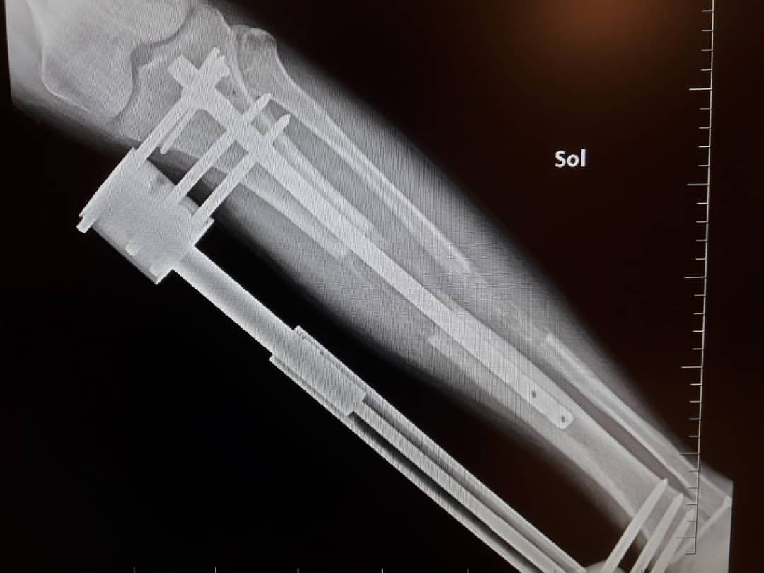 Patient Gallery Leg Lengthening Surgery In Turkey