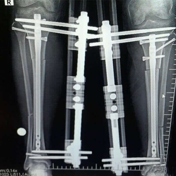 Patient Gallery Leg Lengthening Surgery In Turkey