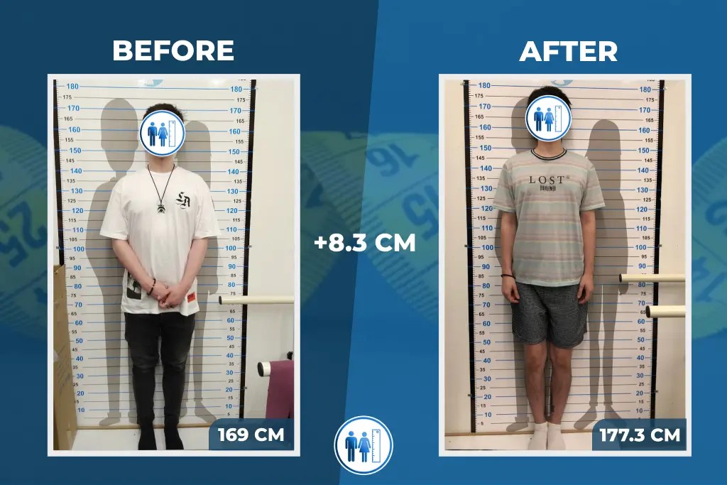 Leg Lengthening Surgery In Turkey