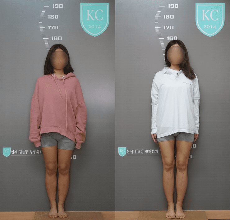 Limb Lengthening Surgery Before and After Photos Limb Lengthening Surgeon Dr. Chung