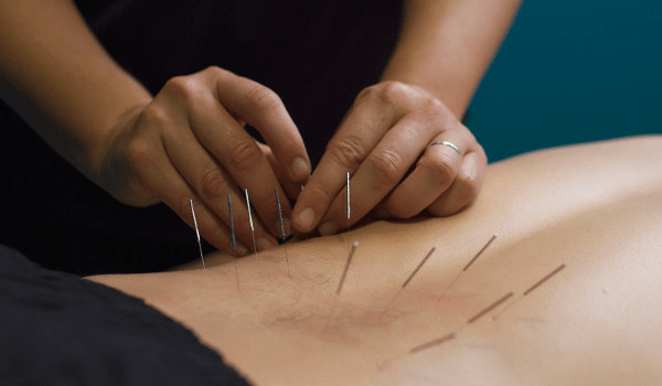 Acupuncture Dry Needling Near Me Acupuncture Acupressure Points