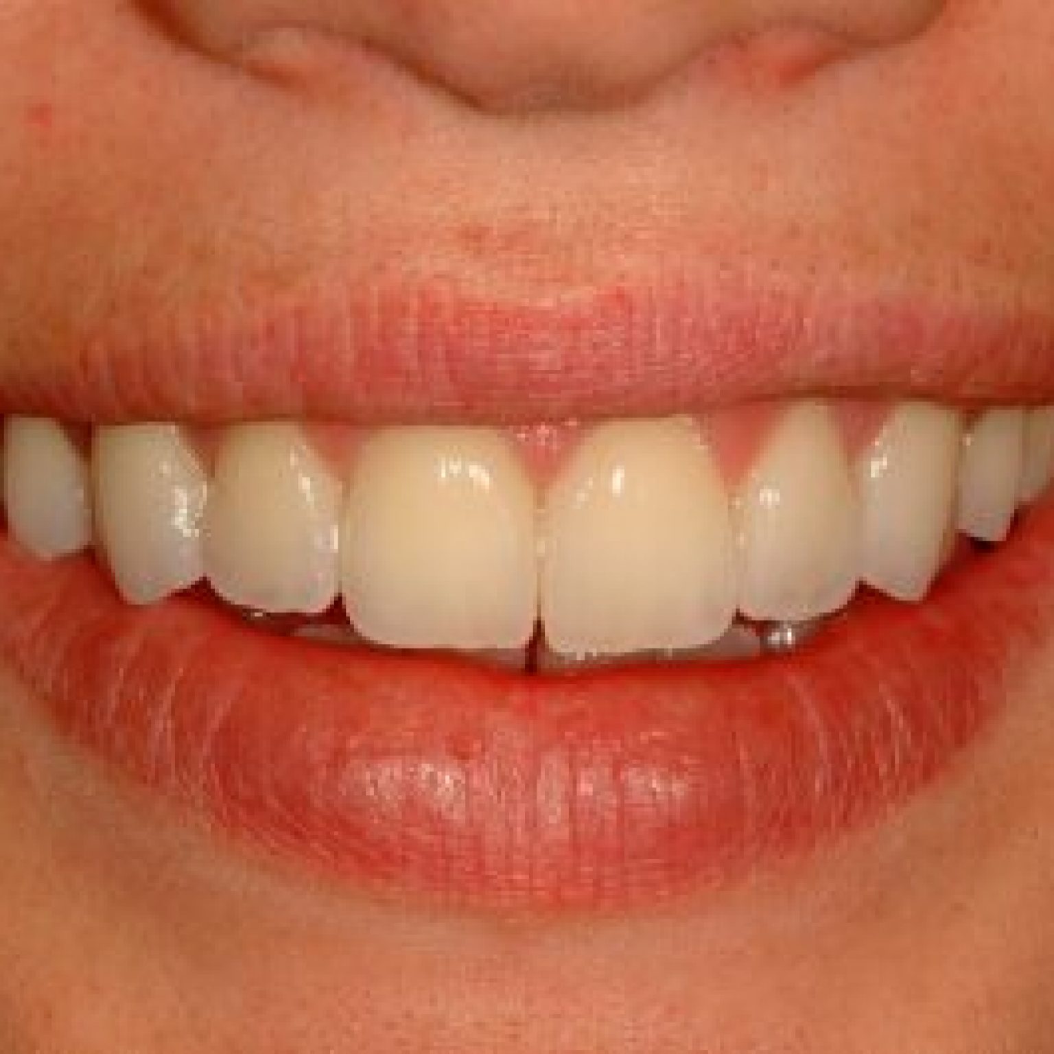 Dental Veneers and Your Smile Lincoln Dentist NE