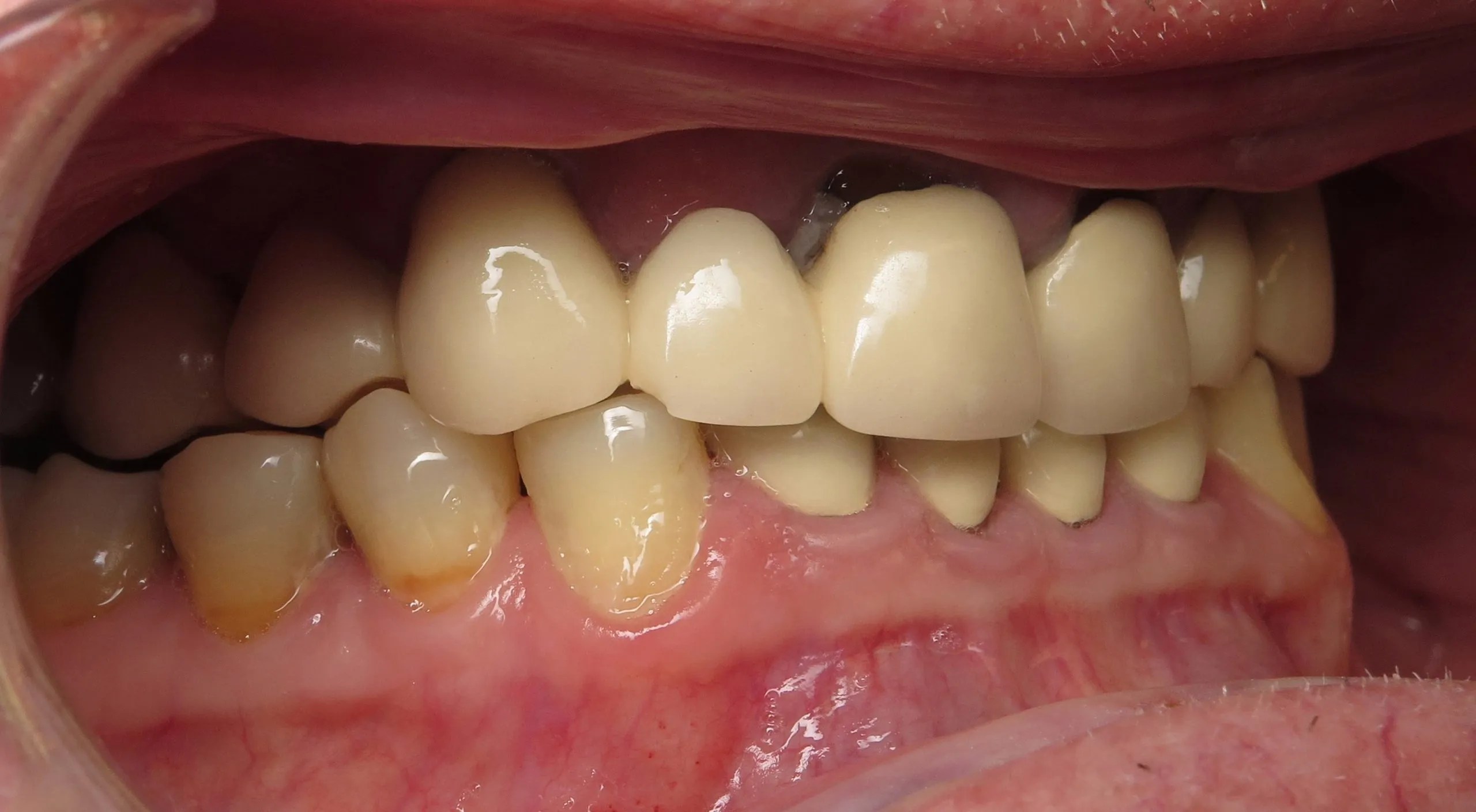 Rockford, IL Dentist Lindsten Dentistry Smile Gallery