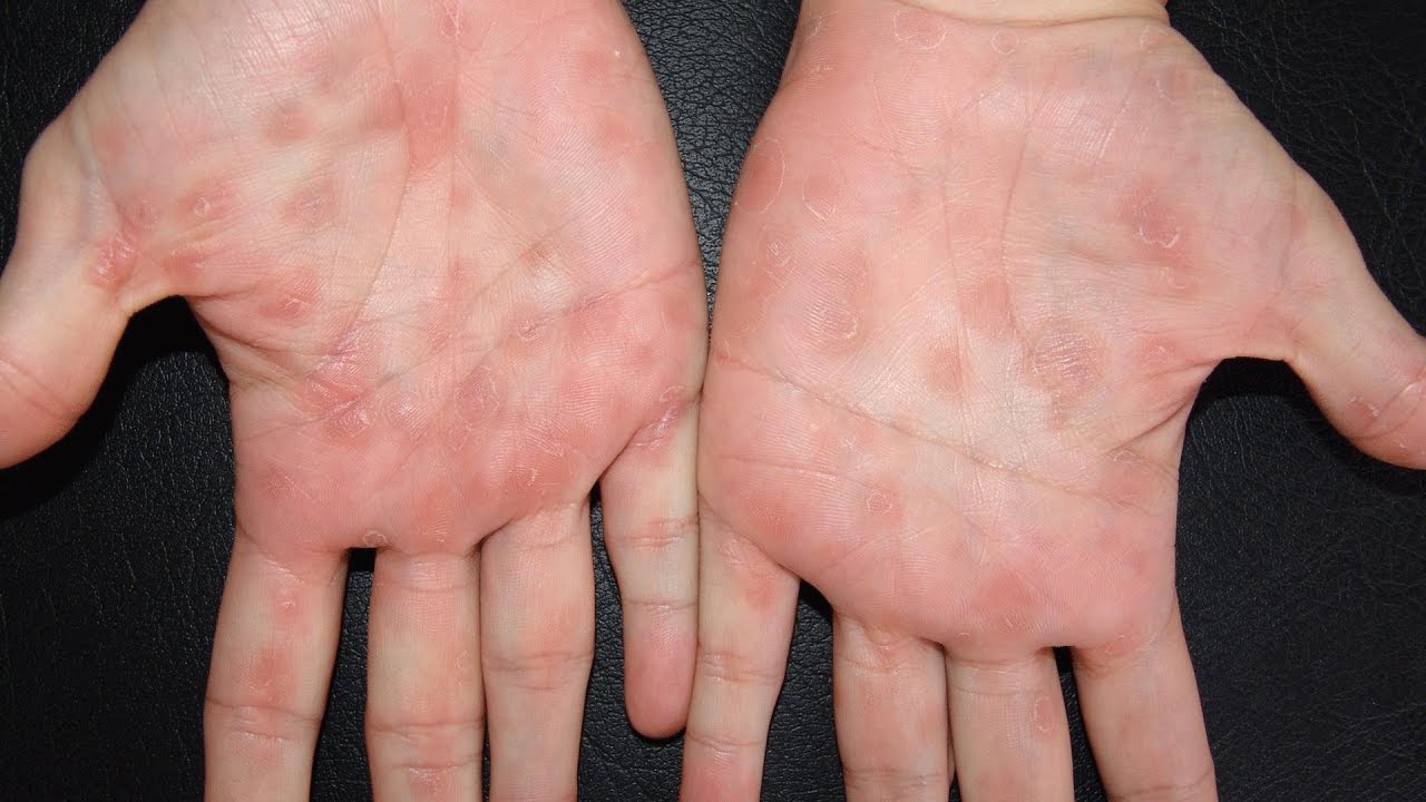 Sifilis Ada StadiumStadium nya loh, Berikut Penjelasannya!