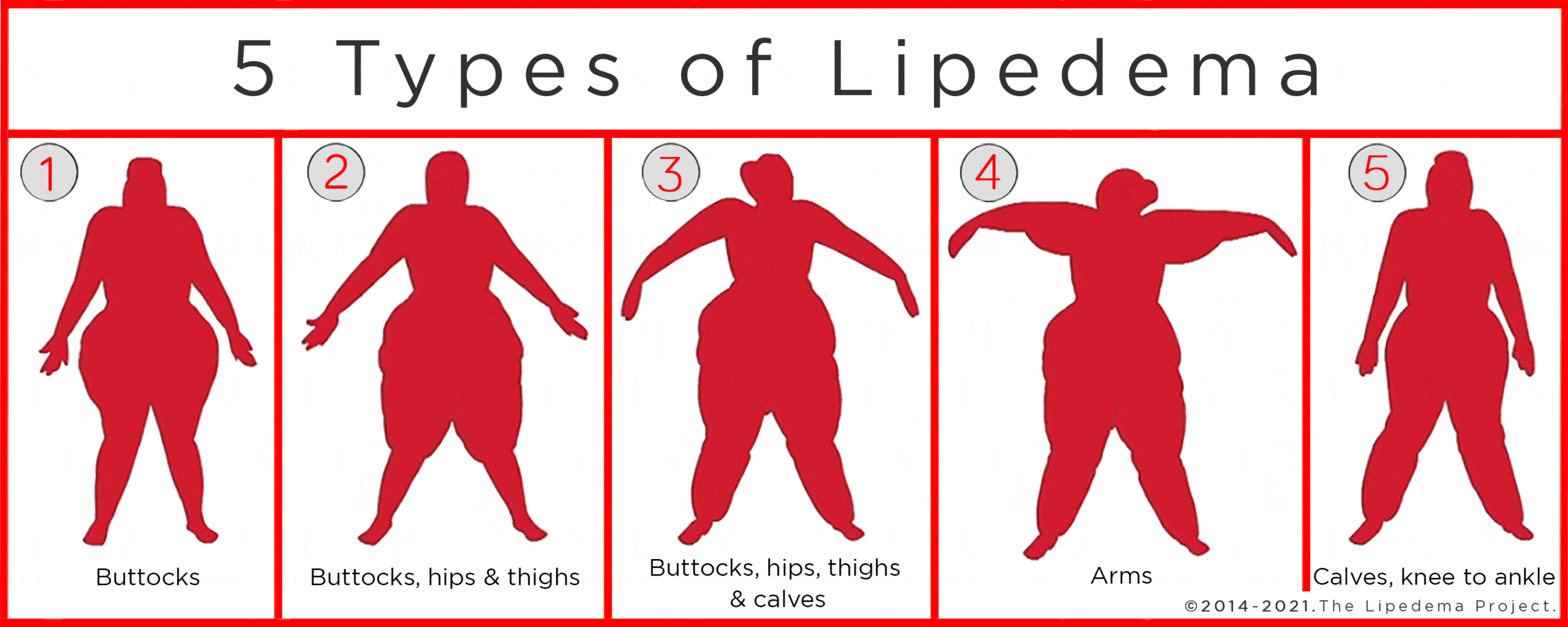 Back and Introduction to Lipedema Lipedema Simplified