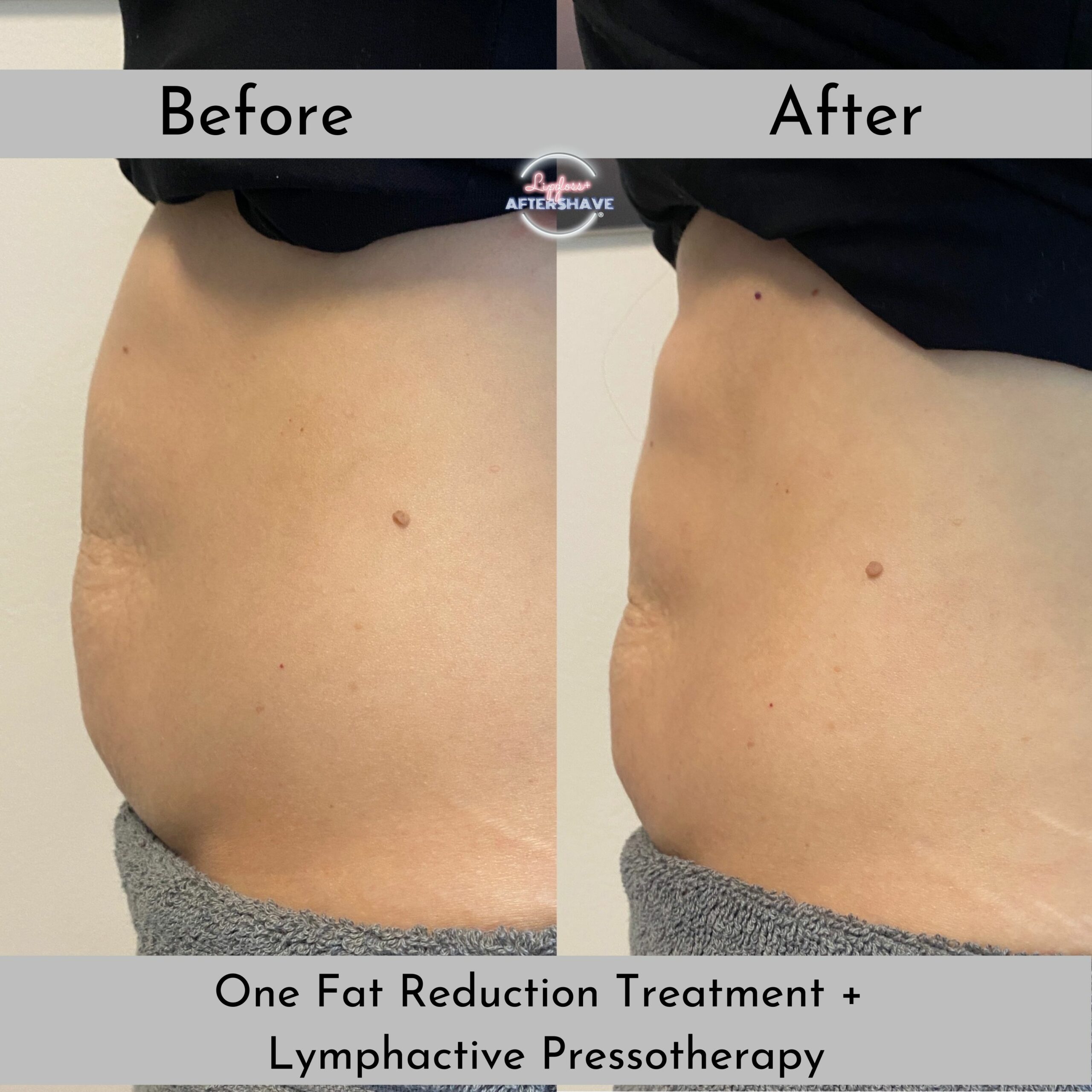 Pro Review of STAR TSHOCK's 2 Areas Face + Tummy Results