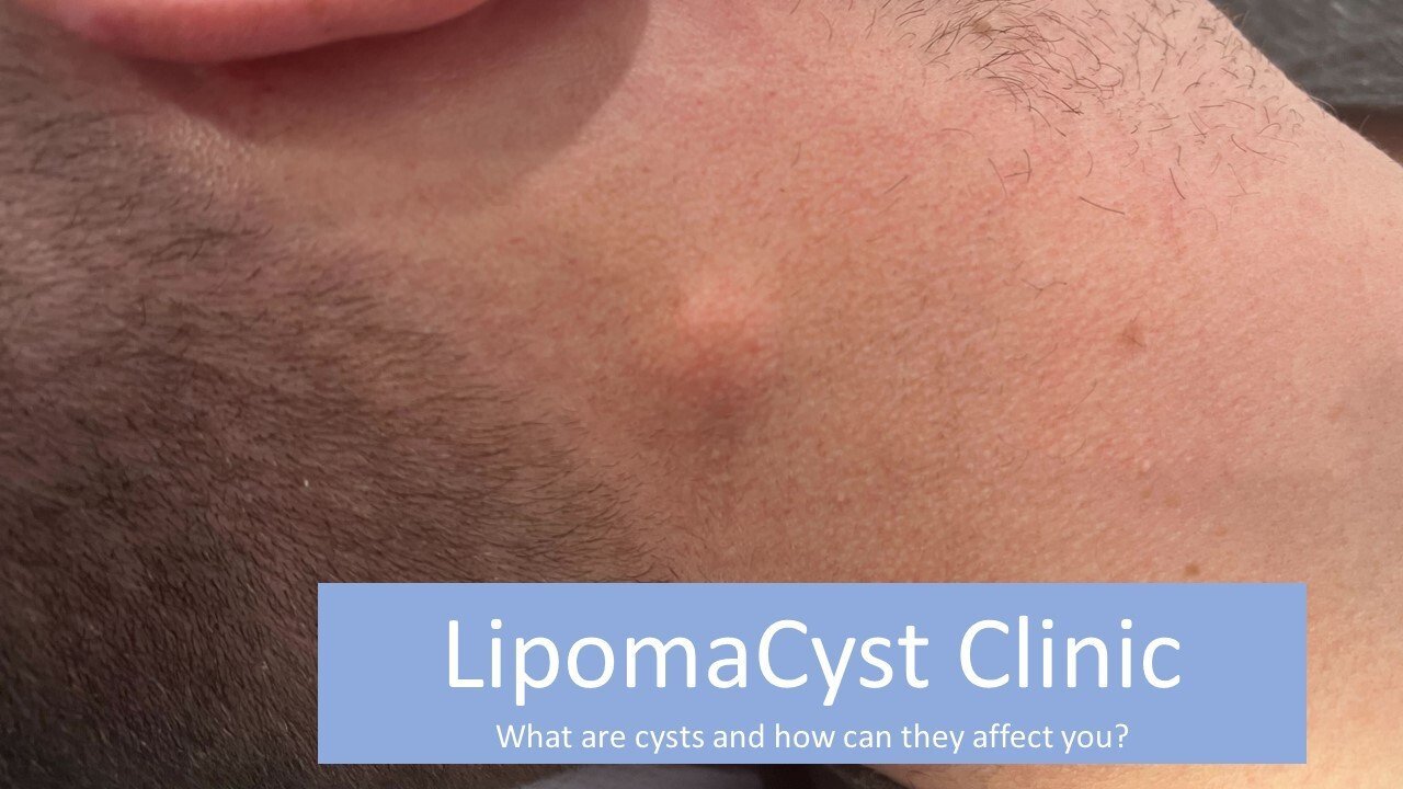 Cyst Removal Lipoma & Cyst Specialists