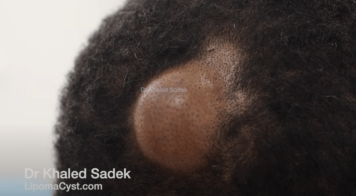 Complete Sebaceous Cyst Sac Removal at LipomaCyst Clinic LipomaCyst