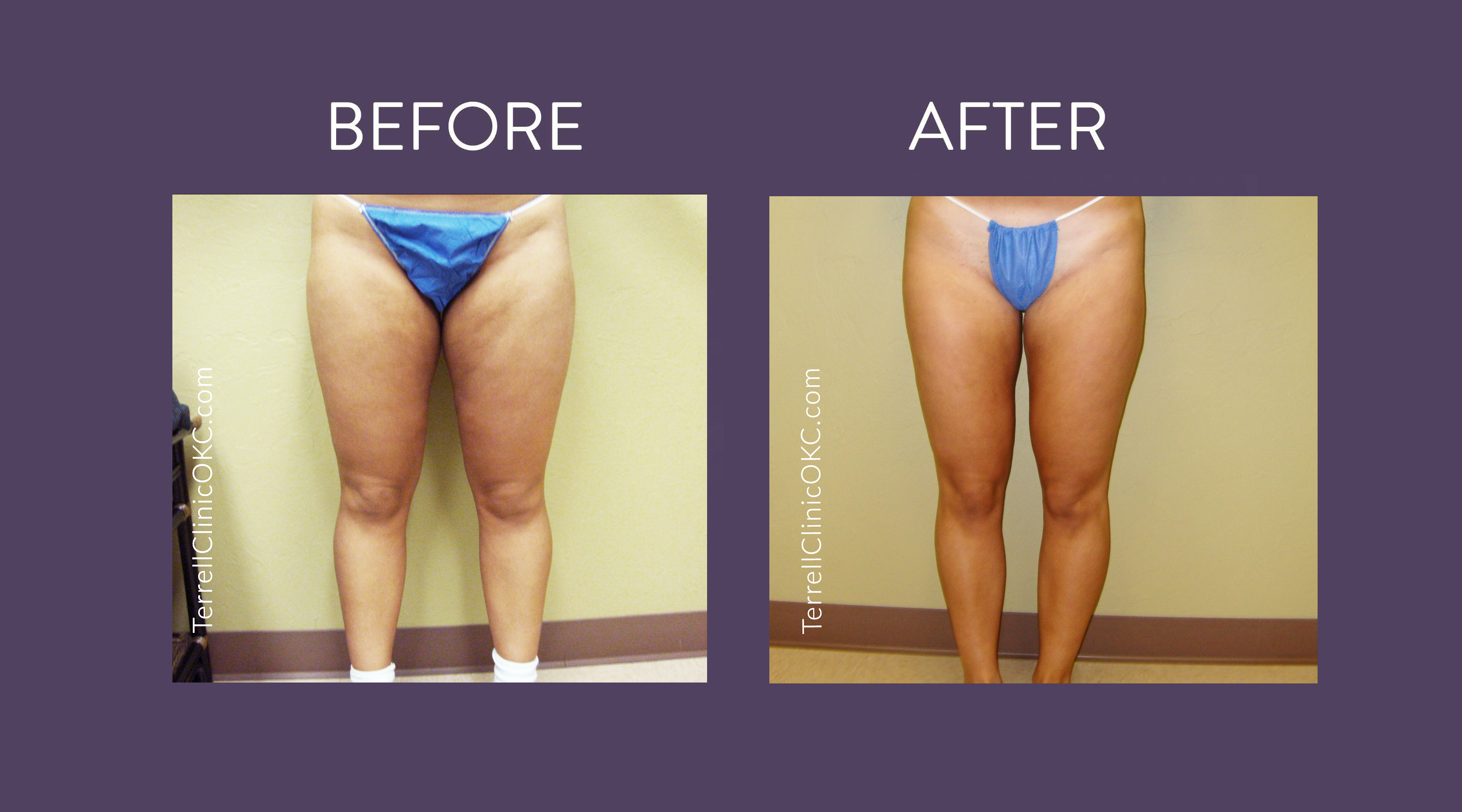 Smart Liposuction Terrell Clinic in Oklahoma City
