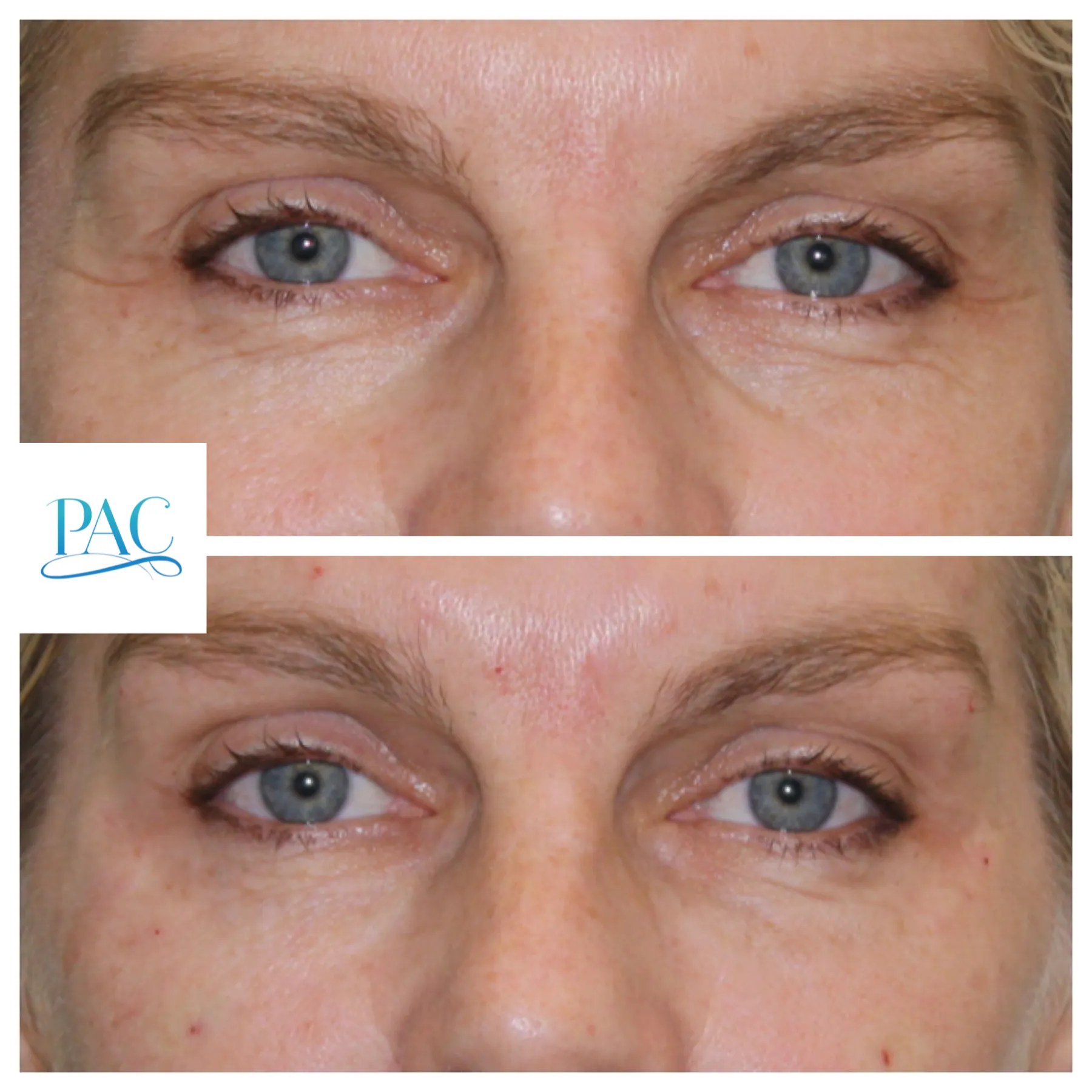 Dermal Fillers Prestige Aesthetics Clinic Boca Raton