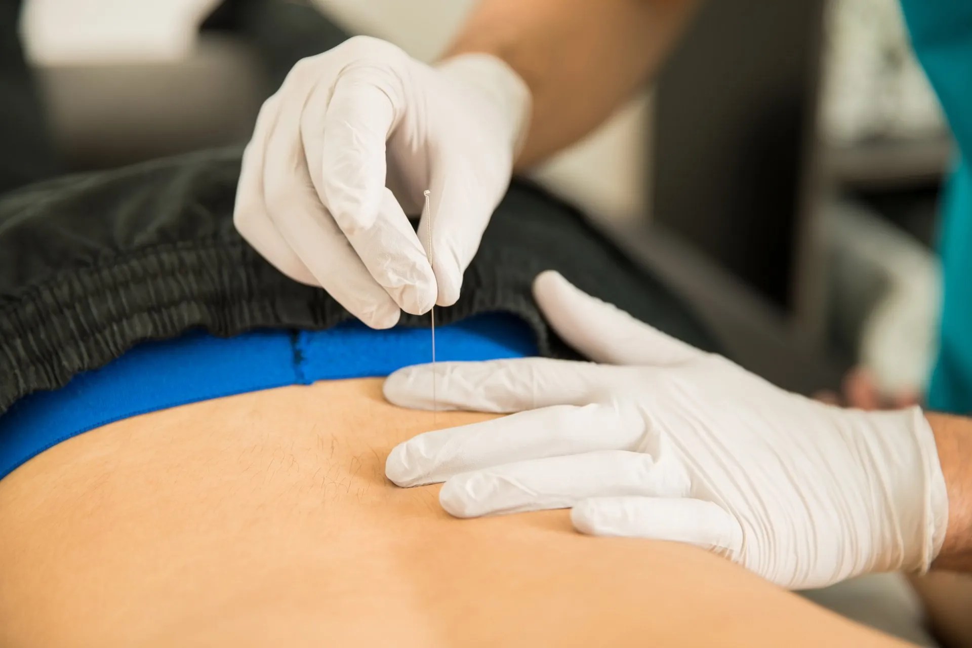 Dry Needling in Gersthofen